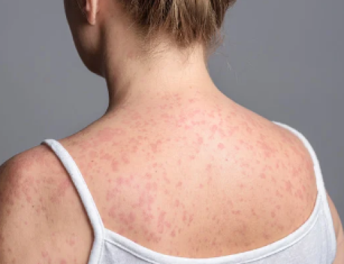 Measles Fact Sheet