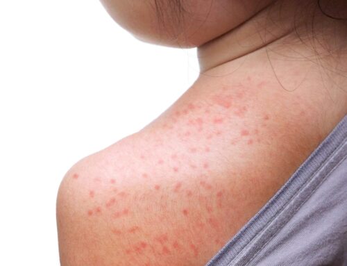 Should I be worried about Measles?